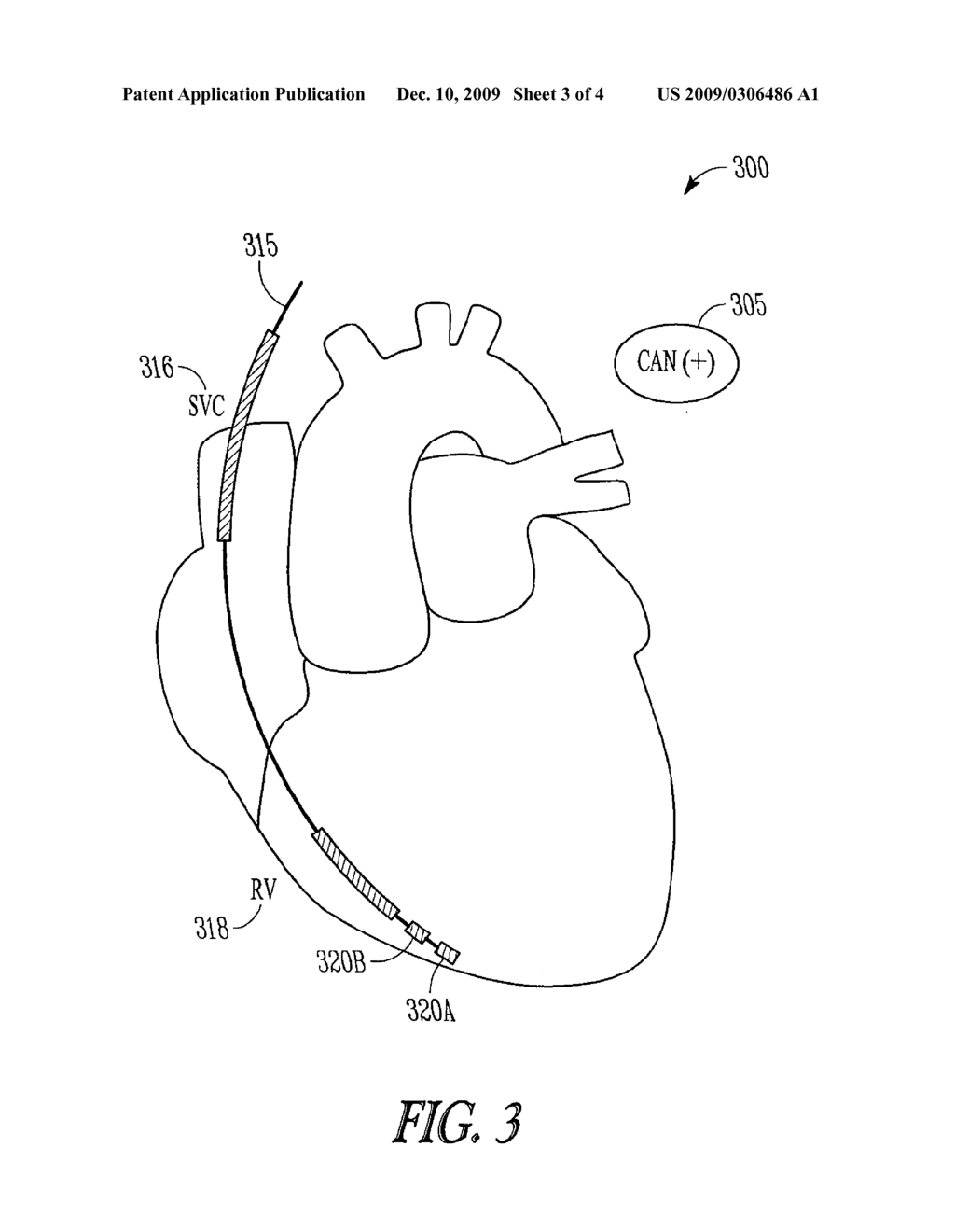 SENSING VECTOR CONFIGURATION IN ICD TO ASSIST ARRHYTHMIA DETECTION AND ANNOTATION - diagram, schematic, and image 04