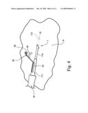 Stabilization of a catheter or cannula diagram and image