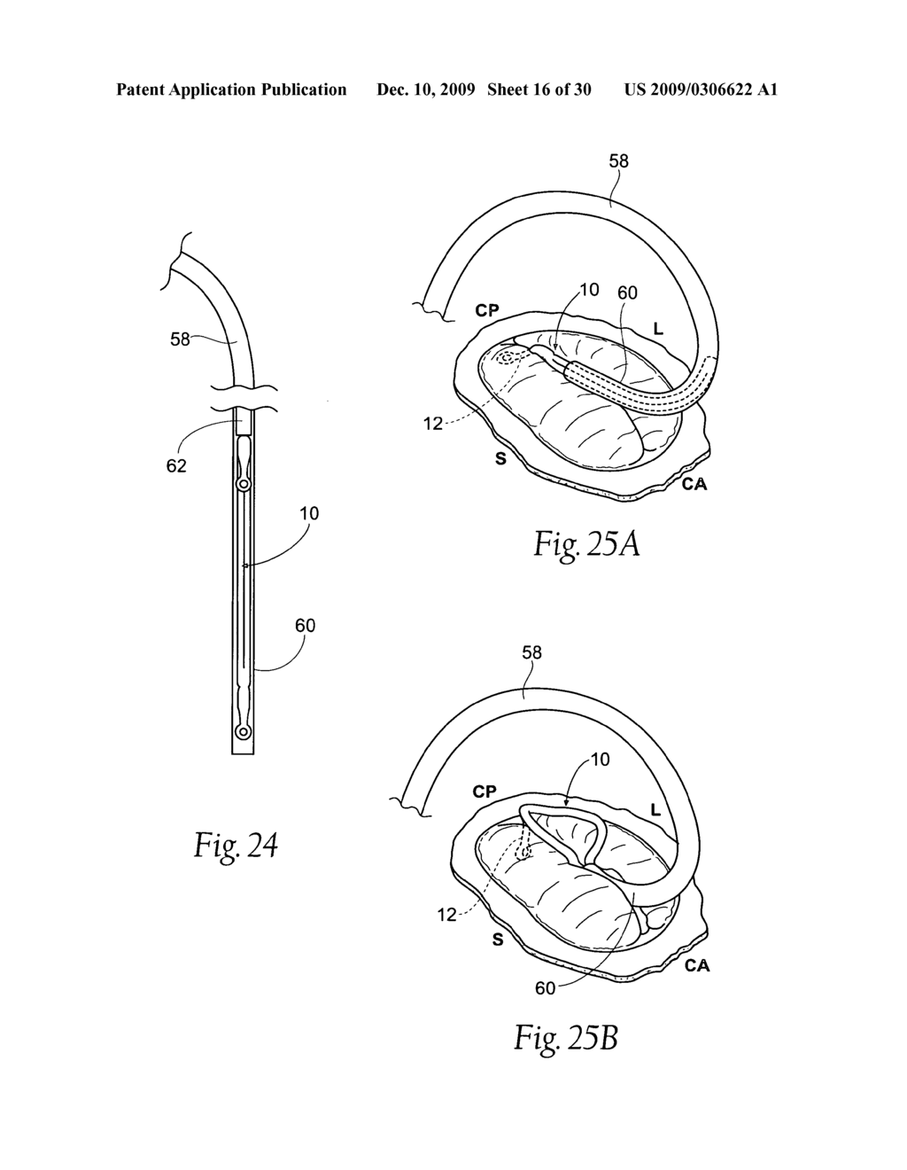 Devices, systems, and methods for reshaping a heat valve annulus - diagram, schematic, and image 17