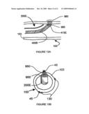 SYSTEMS, ASSEMBLIES, AND METHODS FOR TREATING A BRONCHIAL TREE diagram and image