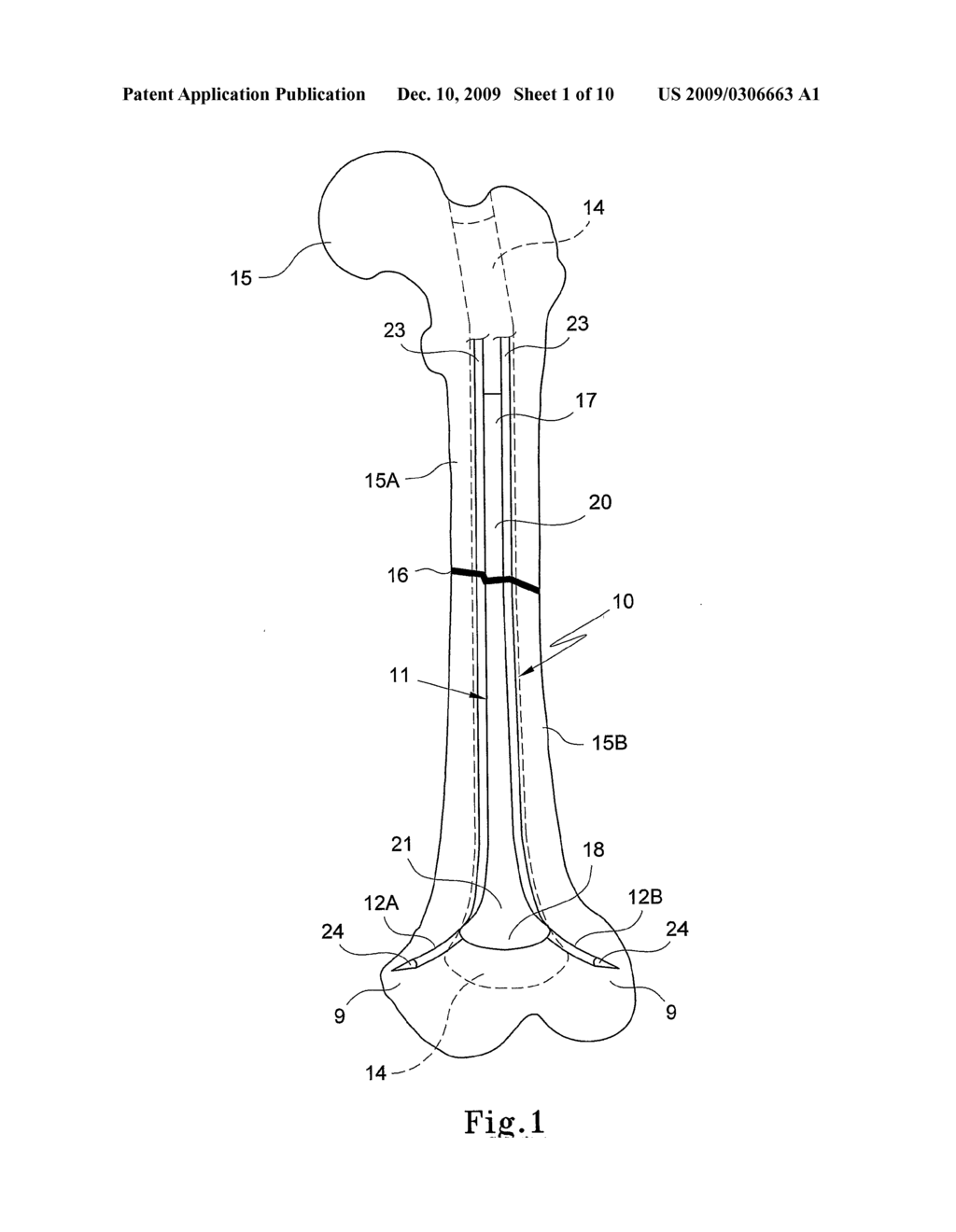 Bone Fixation Device - diagram, schematic, and image 02