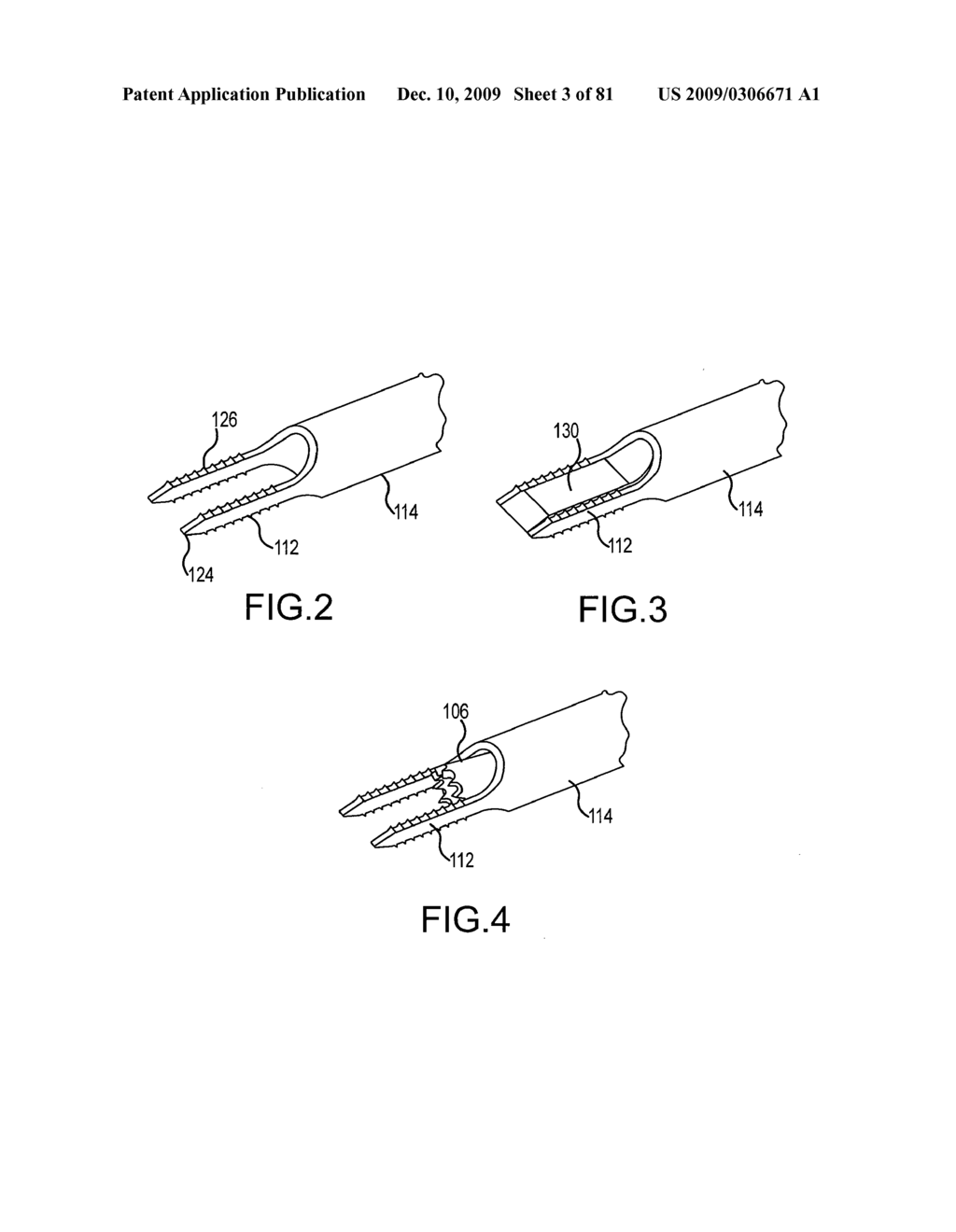 Facet joint implants and delivery tools - diagram, schematic, and image 04