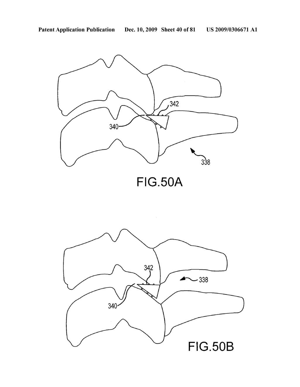 Facet joint implants and delivery tools - diagram, schematic, and image 41