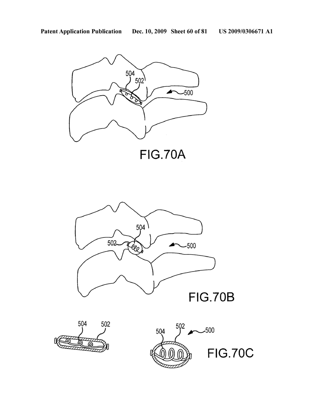 Facet joint implants and delivery tools - diagram, schematic, and image 61