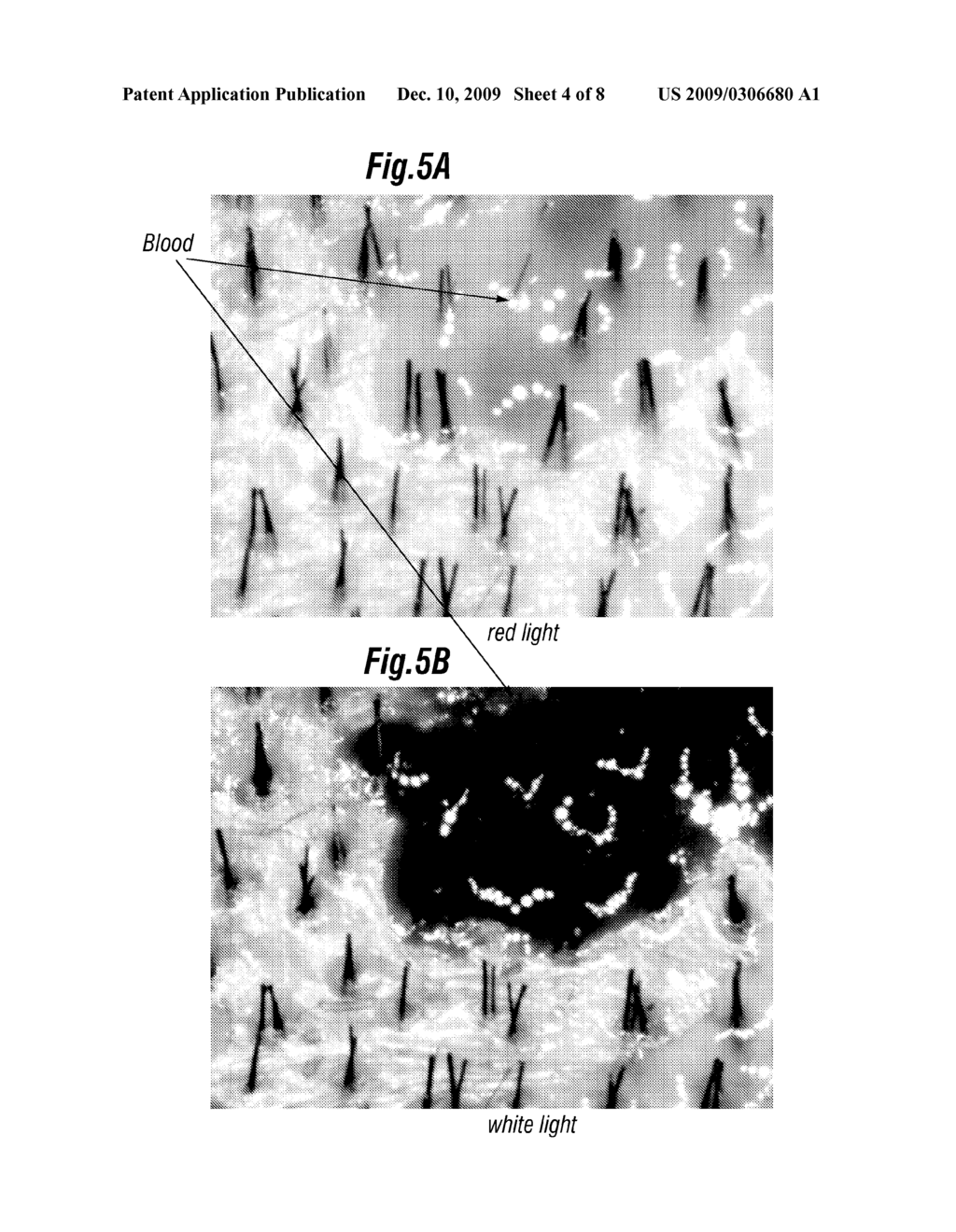 SYSTEM AND METHOD FOR SELECTING FOLLICULAR UNITS FOR HARVESTING - diagram, schematic, and image 05