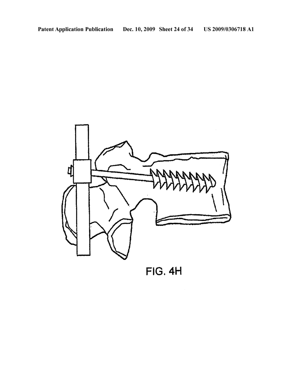 FILAMENT AND CAP SYSTEMS AND METHODS FOR THE FIXATION OF BONE FRACTURES - diagram, schematic, and image 25