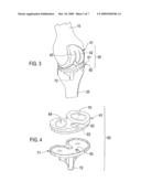 Total Knee Prosthesis and Method for Total Knee Arthroplasty diagram and image