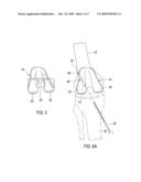 Total Knee Prosthesis and Method for Total Knee Arthroplasty diagram and image