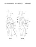 Total Knee Prosthesis and Method for Total Knee Arthroplasty diagram and image