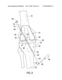 Total Knee Prosthesis and Method for Total Knee Arthroplasty diagram and image