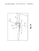 Temporary Arm Gain and Saddle diagram and image