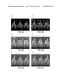 Method and System for Automatic Detection and Measurement of Mitral Valve Inflow Patterns in Doppler Echocardiography diagram and image