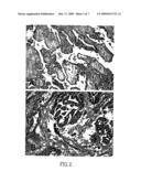 ASBESTOS EXPOSURE, PLEURAL MESOTHELIOMA, AND SERUM OSTEOPONTIN LEVELS diagram and image