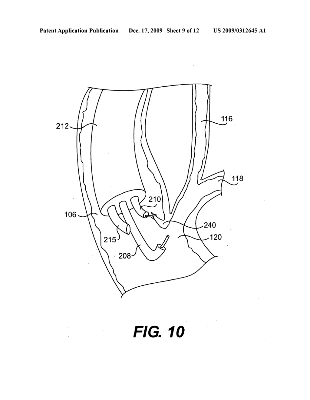 Methods and Devices for Accessing Anatomic Structures - diagram, schematic, and image 10