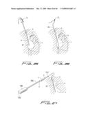 Dialysis Catheter diagram and image