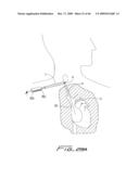 Dialysis Catheter diagram and image