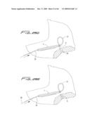 Dialysis Catheter diagram and image