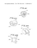 Dialysis Catheter diagram and image