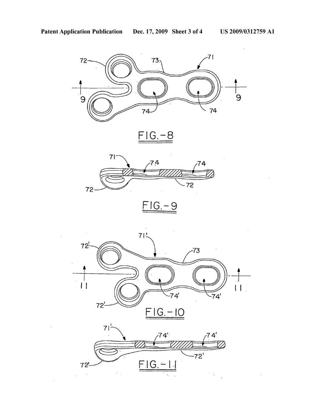 Orthopedic plate for use in fibula repair - diagram, schematic, and image 04