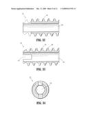 SUTURE ANCHORS diagram and image