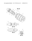 SUTURE ANCHORS diagram and image