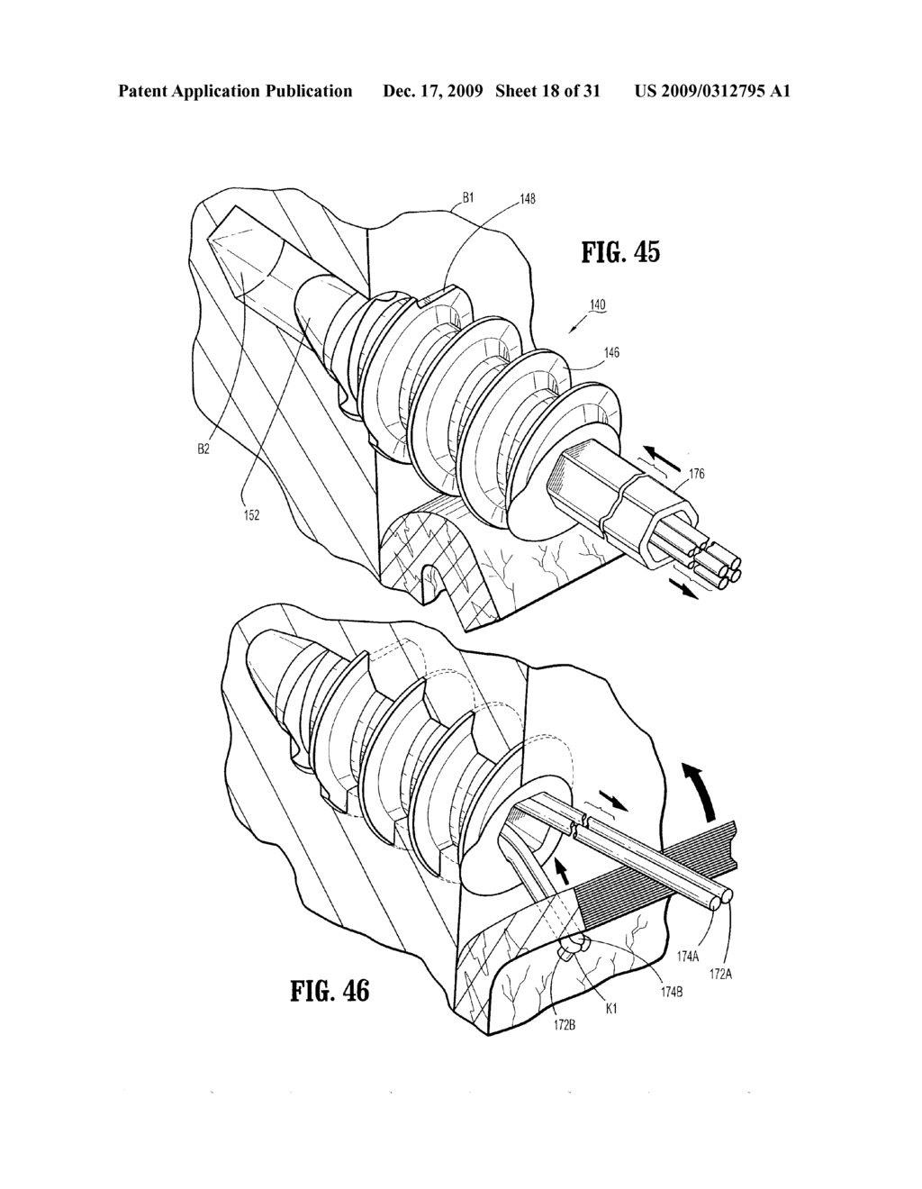 SUTURE ANCHORS - diagram, schematic, and image 19