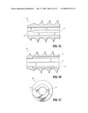 SUTURE ANCHORS diagram and image