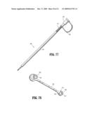 SUTURE ANCHORS diagram and image