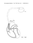 CARDIOMECHANICAL ASSESSMENT FOR CARDIAC RESYNCHRONIZATION THERAPY diagram and image