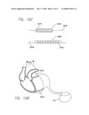 CARDIOMECHANICAL ASSESSMENT FOR CARDIAC RESYNCHRONIZATION THERAPY diagram and image