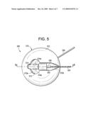 Disposable Patch and Reusable Sensor Assembly for Use in Medical Device Localization and Mapping Systems diagram and image