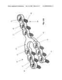 Osteosynthesis Plate Comprising Through-Openings Which are Inclined in Relation to the Plane of the Plate diagram and image