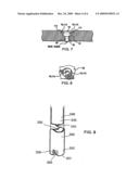 BONE SCREW REMOVAL SYSTEM diagram and image