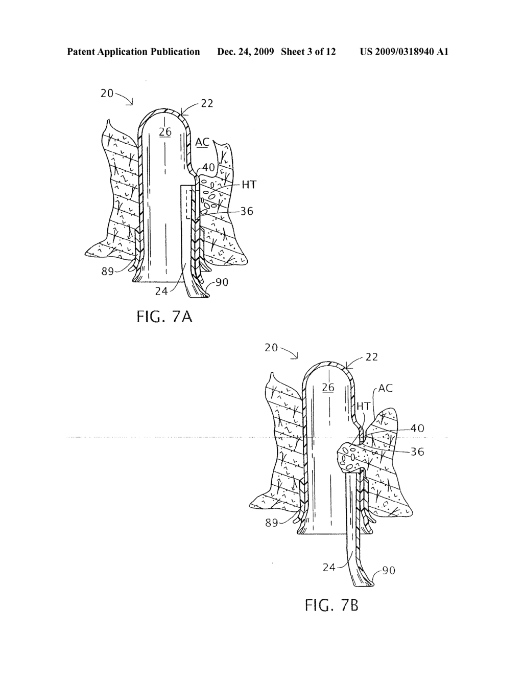 ENDOLUMINAL TREATMENT METHOD AND ASSOCIATED SURGICAL ASSEMBLY INCLUDING TISSUE OCCLUSION DEVICE - diagram, schematic, and image 04