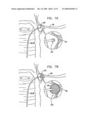 FIBROID TREATMENT APPARATUS AND METHOD diagram and image