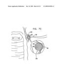 FIBROID TREATMENT APPARATUS AND METHOD diagram and image