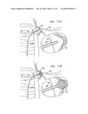 FIBROID TREATMENT APPARATUS AND METHOD diagram and image