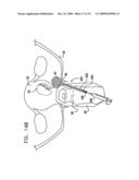 FIBROID TREATMENT APPARATUS AND METHOD diagram and image