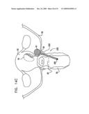 FIBROID TREATMENT APPARATUS AND METHOD diagram and image