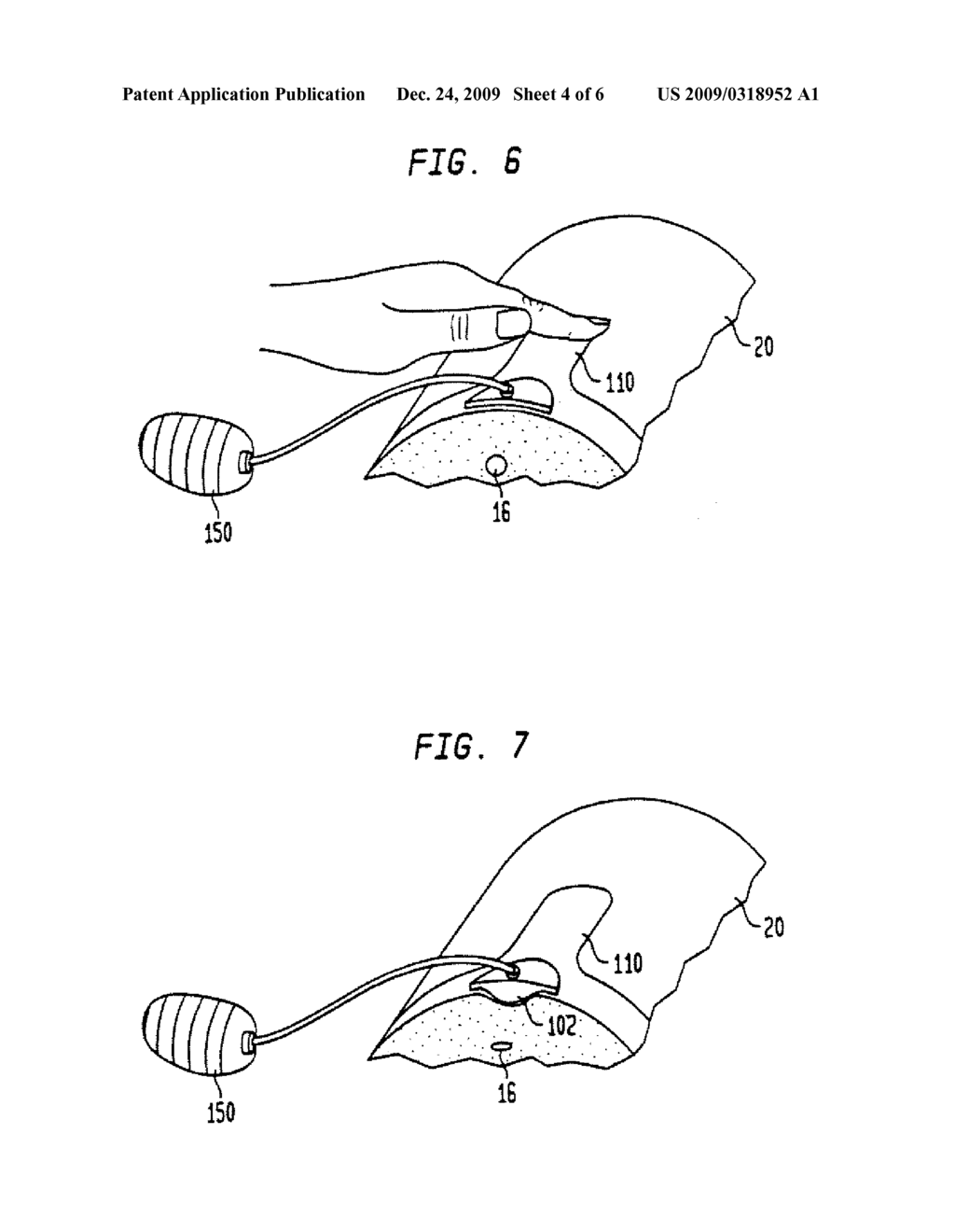 DEVICE AND METHOD FOR COMPRESSING WOUNDS - diagram, schematic, and image 05