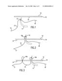 METHOD OF SUTURING diagram and image