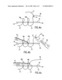 METHOD OF SUTURING diagram and image