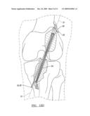 Method and Apparatus for Coupling Soft Tissue to a Bone diagram and image