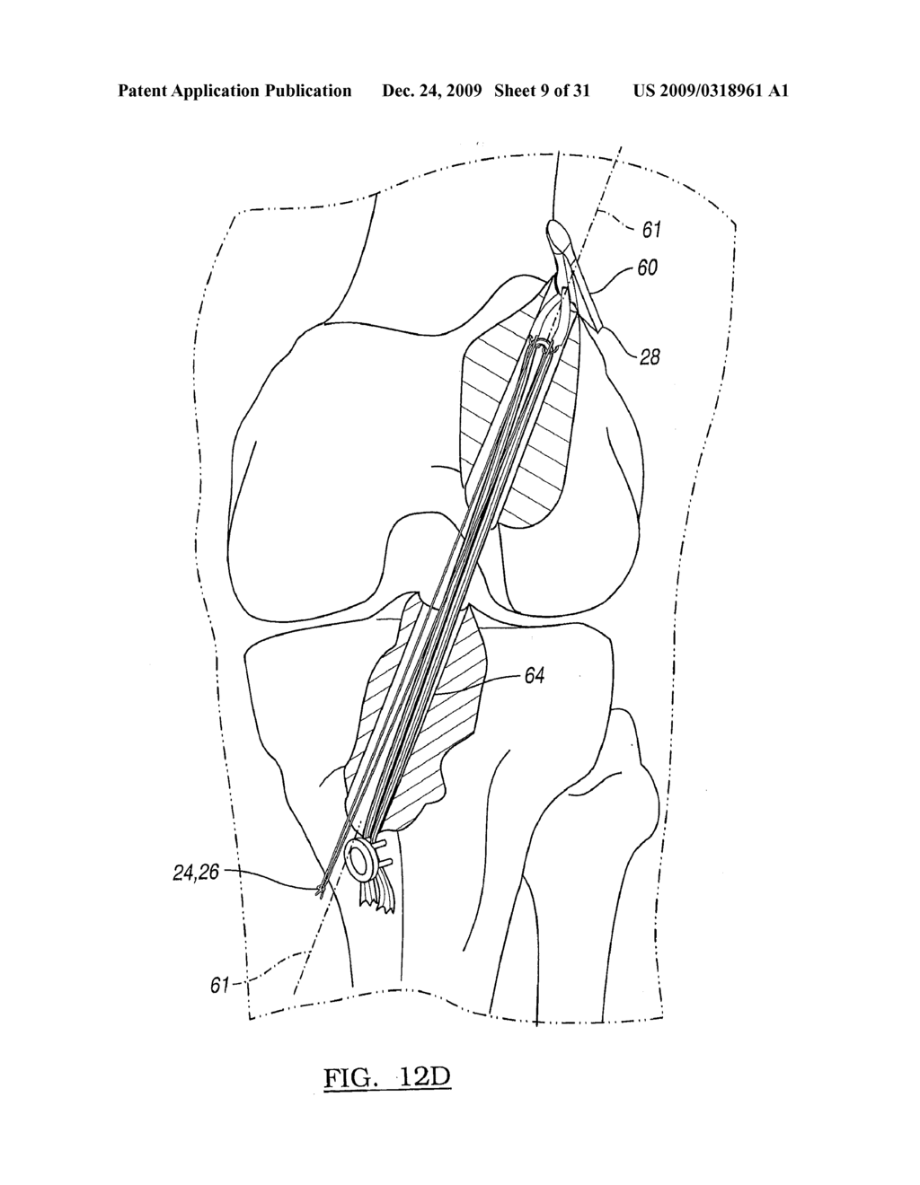 Method and Apparatus for Coupling Soft Tissue to a Bone - diagram, schematic, and image 10