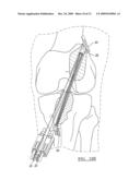 Method and Apparatus for Coupling Soft Tissue to a Bone diagram and image