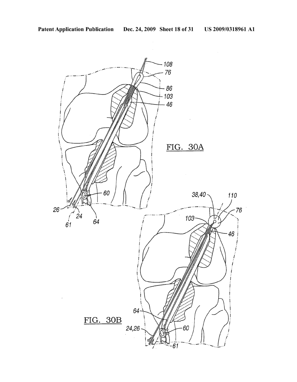 Method and Apparatus for Coupling Soft Tissue to a Bone - diagram, schematic, and image 19