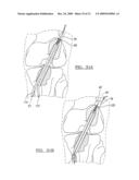 Method and Apparatus for Coupling Soft Tissue to a Bone diagram and image