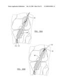 Method and Apparatus for Coupling Soft Tissue to a Bone diagram and image