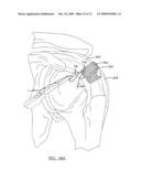 Method and Apparatus for Coupling Soft Tissue to a Bone diagram and image