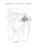 Method and Apparatus for Coupling Soft Tissue to a Bone diagram and image